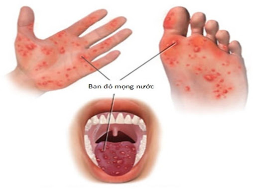 Bệnh tay chân miệng Nguyên nhân, dấu hiệu và cách phòng ngừa