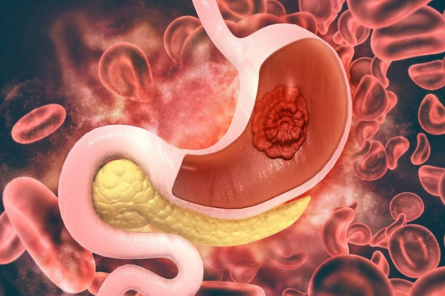 Viêm loét dạ dày tá tràng chiếm phần lớn trong bệnh dạ dày.