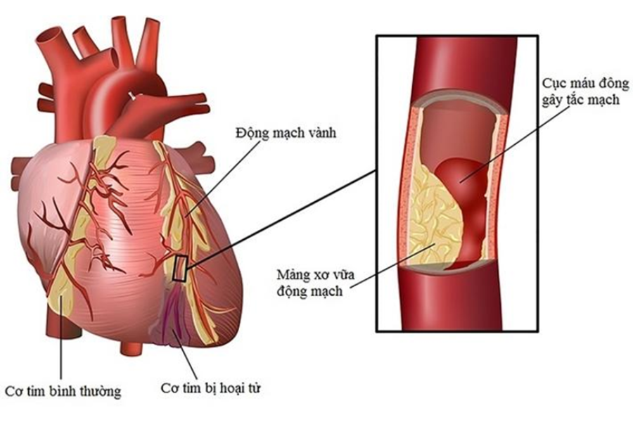 Bệnh động mạch vành là nguyên nhân thường gặp gây suy tim