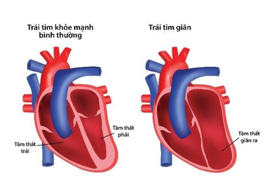 Bệnh cơ tim giãn với đặc trưng giãn các buồng tim, thấy rõ ở 2 tâm thất