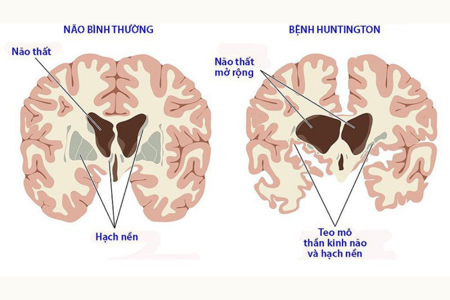 Bệnh Huntington phát triển khi các protein dài bất thường phá hủy các tế bào thần kinh