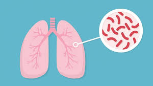 Lao phổi- thể bệnh hay gặp nhất và chiếm 80% tổng số bệnh...