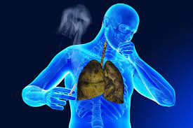 Phân loại tràn khí màng phổi