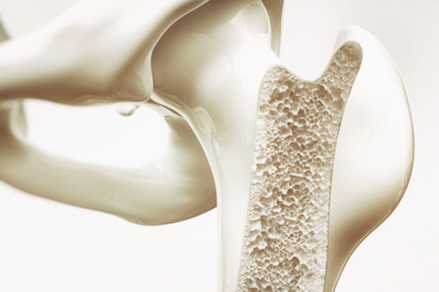 Bệnh loãng xương thường gặp ở người già