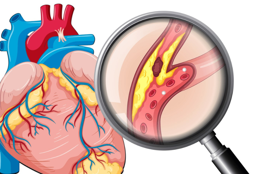 Suy tim và bệnh lý mạch vành: có nguy cơ gây tử vong cao nhất đối với người bệnh tăng huyết áp