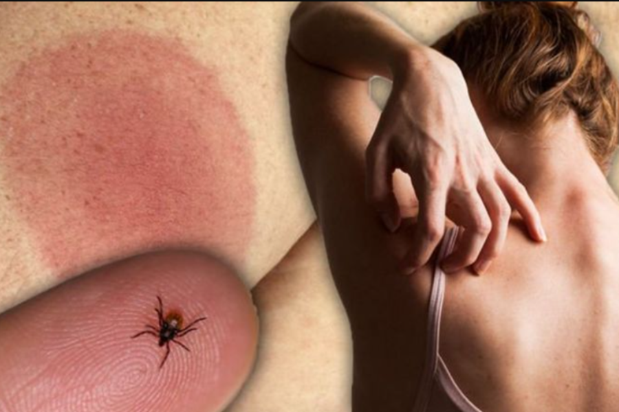 Bệnh Lyme do xoắn khuẩn thông qua bọ chét, bọ ve lây bệnh cho người