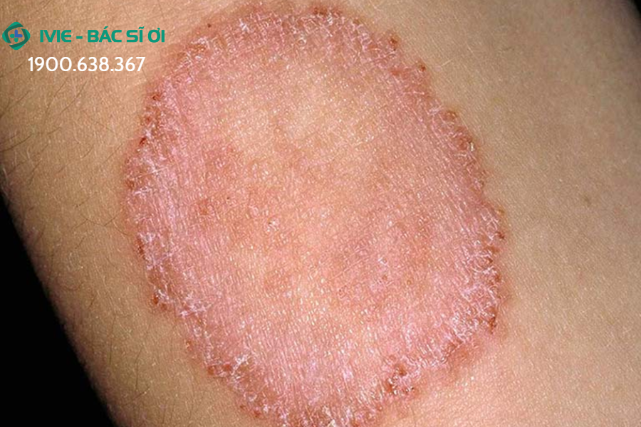 Nấm ngoài da là bệnh thường gặp ở Việt Nam, có tỷ lệ mắc đến 30%