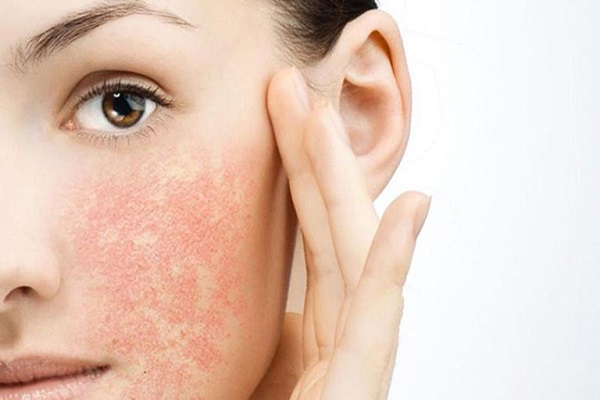 Các nguyên nhân gây ra bệnh ngoài da ở người lớn là gì?
