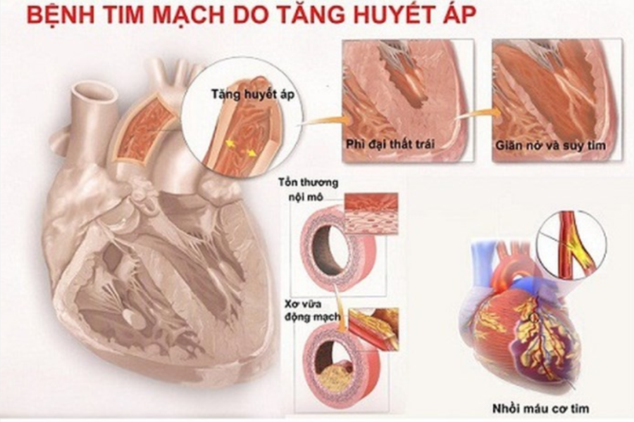 Tăng huyết áp là một trong những nguyên nhân gây suy tim