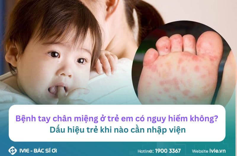 Bệnh tay chân miệng ở trẻ em có nguy hiểm không? Dấu hiệu...