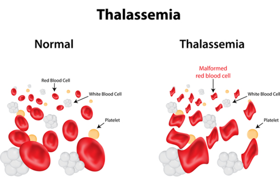 Thalassemia có thể gây thiếu máu nhẹ hoặc nặng