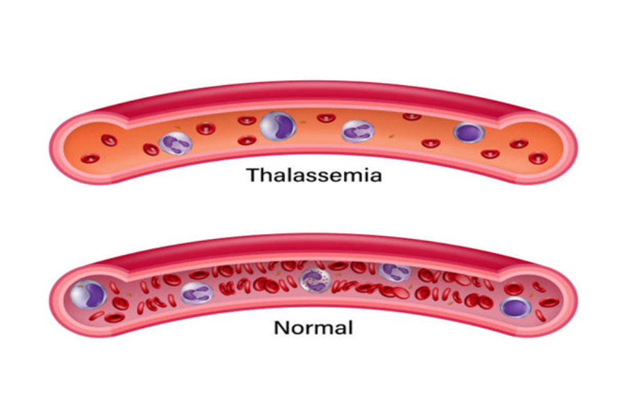 Bệnh thalassemia hay còn gọi là bệnh tan máu bẩm sinh