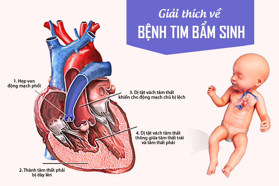 Bệnh tim bẩm sinh là một nguyên nhân gây tử vong ở trẻ sơ sinh 