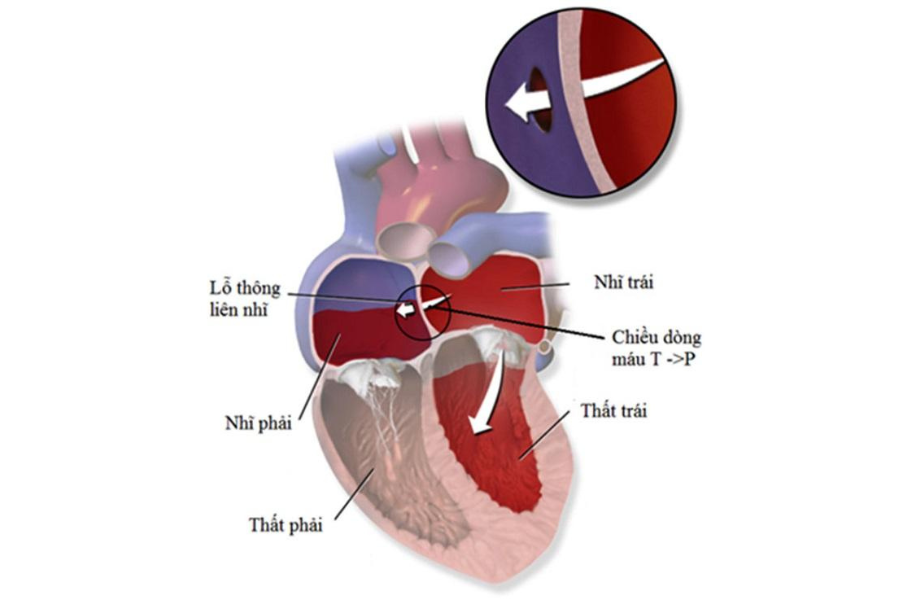 Thông liên nhĩ: dị tật tim bẩm sinh thường gặp nhất trên trẻ em và người lớn nói chung