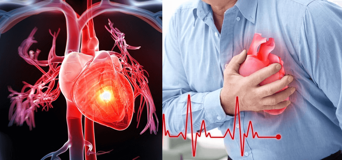 Bệnh tim mạch là gì? Tại sao cần phải khám tầm soát bệnh lý ...