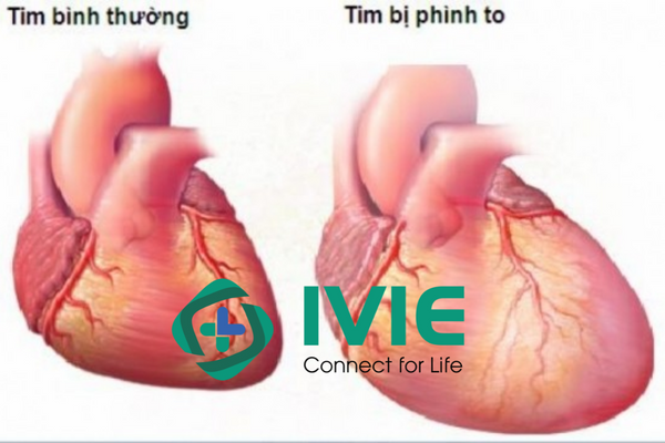 Tìm hiểu nguyên nhân và phương pháp điều trị bệnh tim to