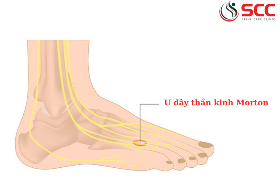 Bệnh U dây thần kinh Morton