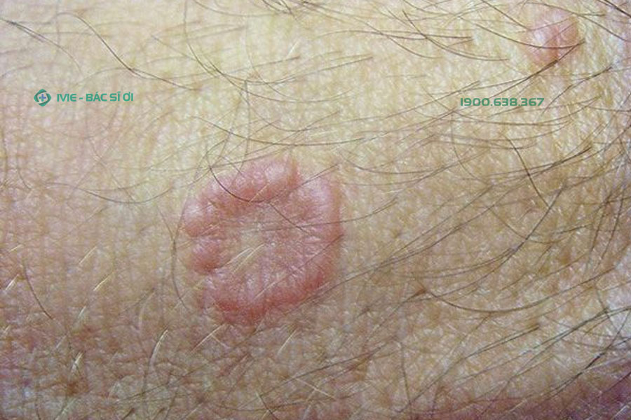 Bệnh u hạt vòng có biểu hiện xuất hiện vết tròn bị nổi đốm đỏ trên da và ngứa