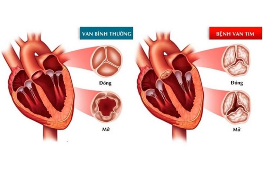 Bệnh van tim là nguyên nhân gây suy tim hàng đầu tại các nước đang phát triển, trong đó có Việt Nam