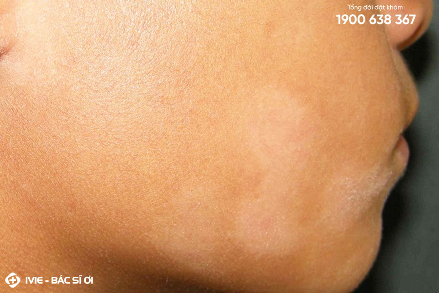 Vảy nến gây ra tình trạng vết loang trắng trên da mặt