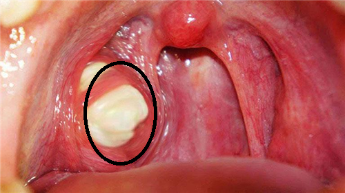 Quá trình loại bỏ sỏi amidan bằng tia Laser có đau không?
