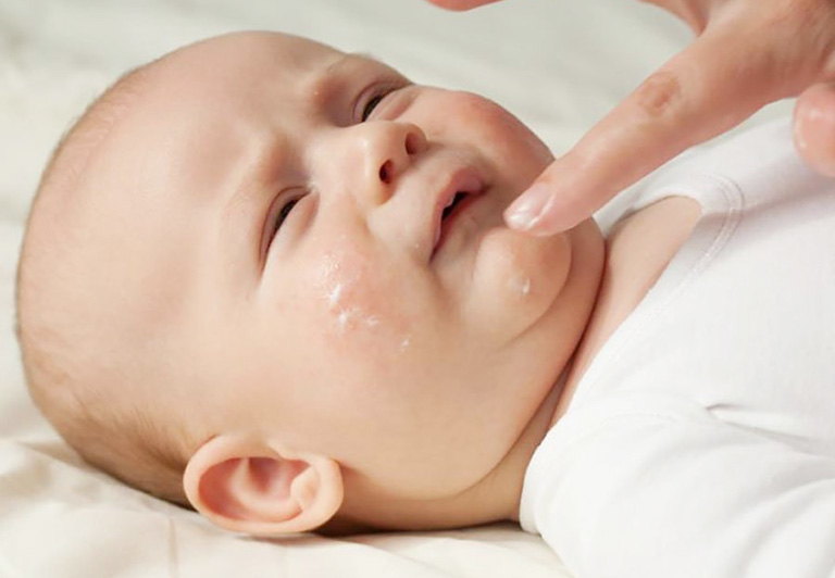 Bệnh viêm da tiếp xúc dị ứng ở trẻ em