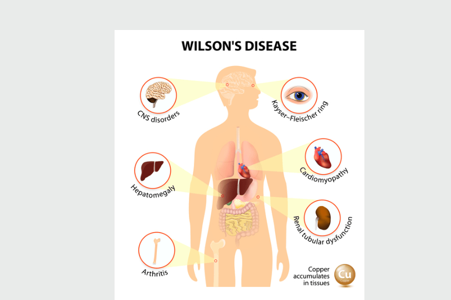 Nguyên nhân bệnh Wilson là một rối loạn di truyền lặn trên NST thường có thể di truyền