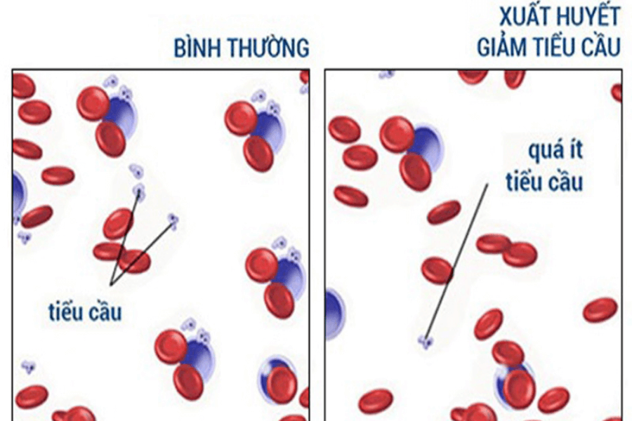 Bệnh xuất huyết giảm tiểu cầu.