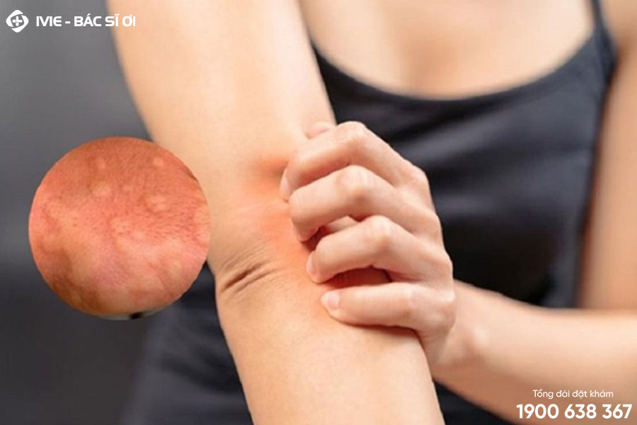 Dị ứng da có thể là nguyên nhân bị ngứa da vào ban đêm