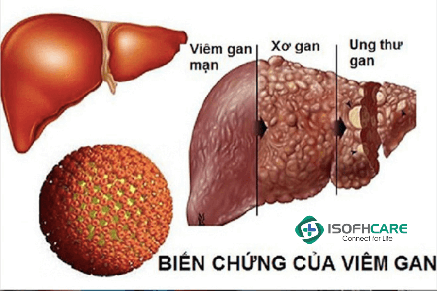 Hiện nay, HBV là nguyên nhân hàng đầu dẫn đến xơ gan, ung thư gan.