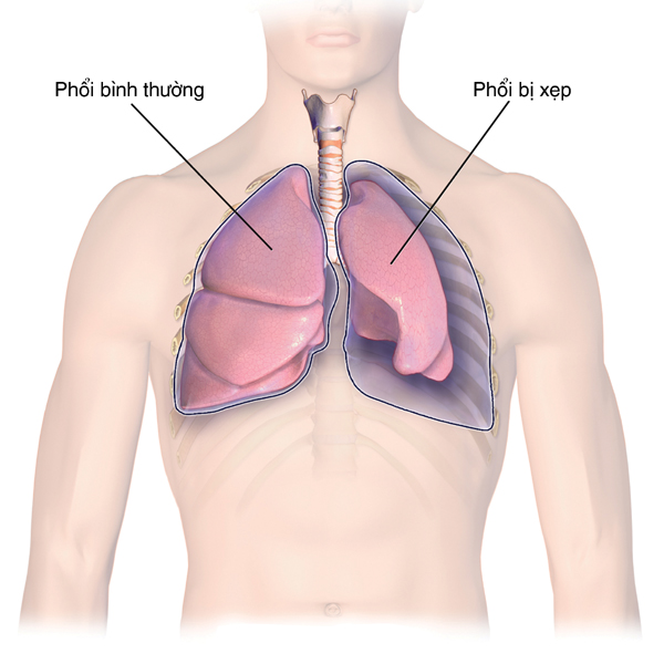 Nguyên nhân gây tràn khí màng phổi
