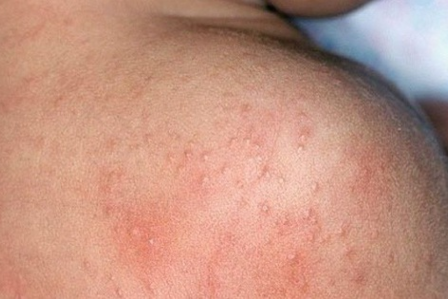 Biểu hiện của rôm sảy