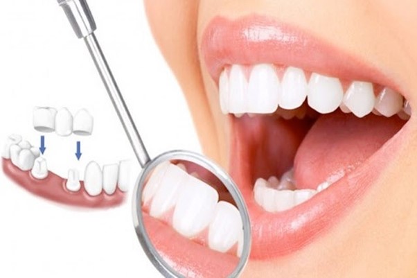 Bọc răng sứ là gì? Những ai nên bọc răng sứ