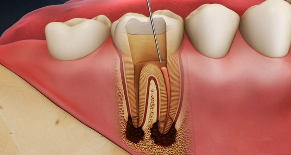 Tổng hợp các bệnh thường gặp ở tủy răng