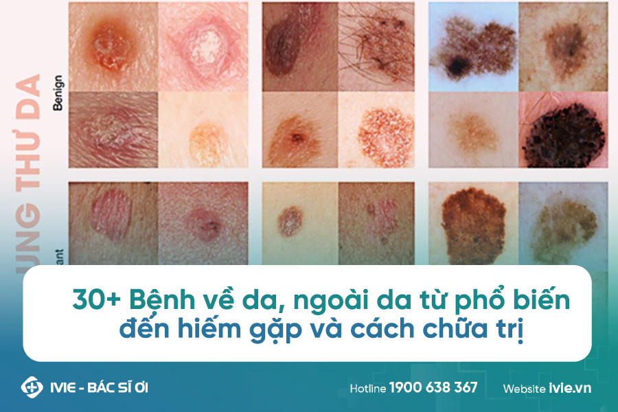 30+ Bệnh về da, ngoài da từ phổ biến đến hiếm gặp và cách...