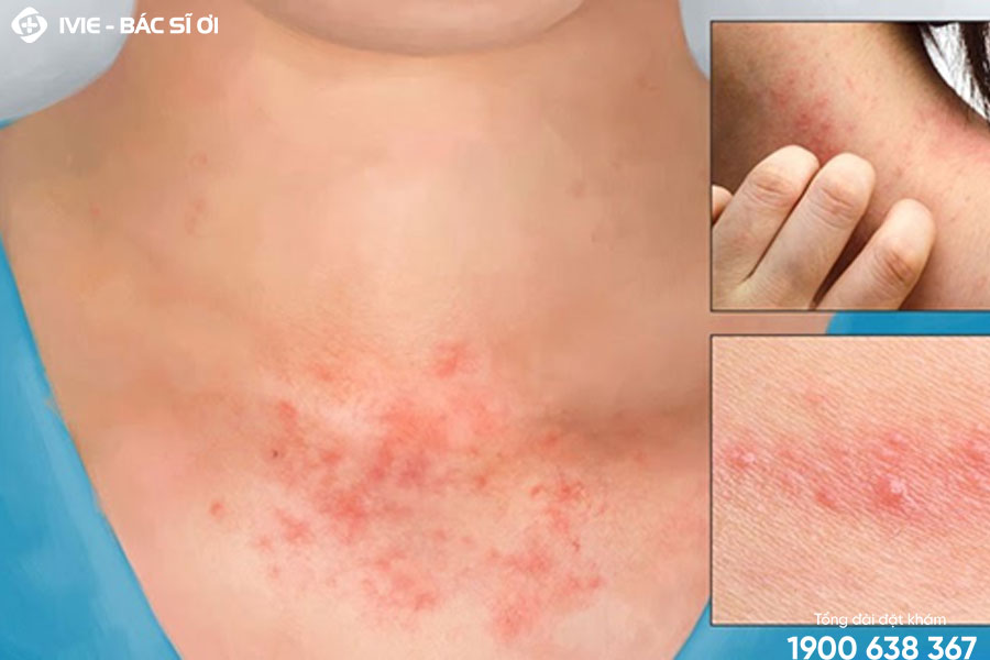Viêm da tiếp xúc là một bệnh lý da do tiếp xúc với các chất dị ứng