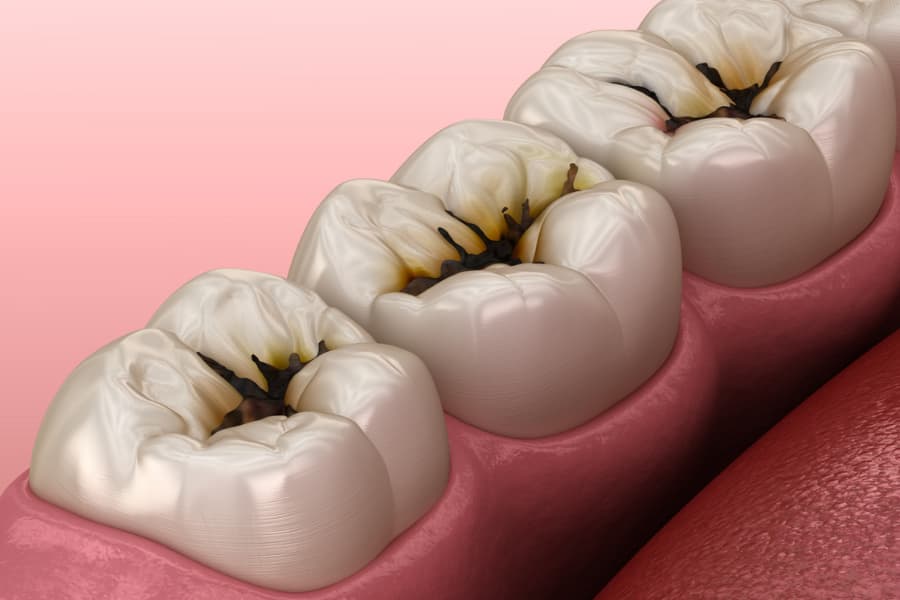 Triệu chứng của sâu răng