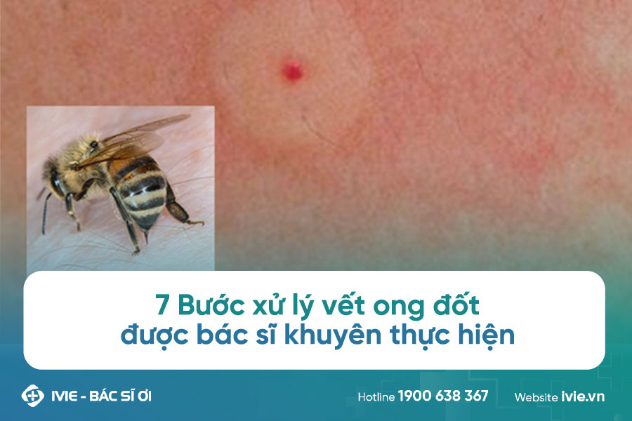 7 Bước xử lý vết ong đốt được bác sĩ khuyên thực hiện