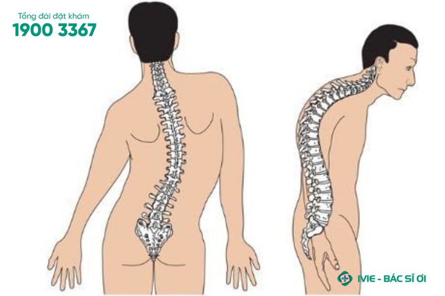 Cong vẹo cột sống ở người trưởng thành