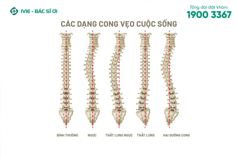 Cong vẹo cột sống có thể xuất hiện tại nhiều vị trí khác nhau