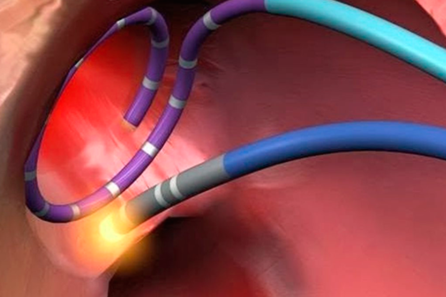 Các điện cực được luồn vào trong buồng tim giúp tìm và triệt đốt các rối loạn nhịp nguy hiểm