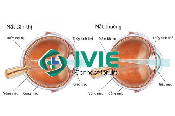Các phương pháp phẫu thuật cận thị tại Bệnh viện Mắt HITEC