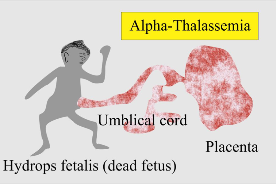Thể bệnh Alpha thalassemia