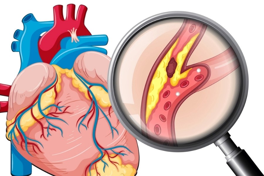 Bệnh về tim mạch là vấn đề nghiêm trọng hiện nay