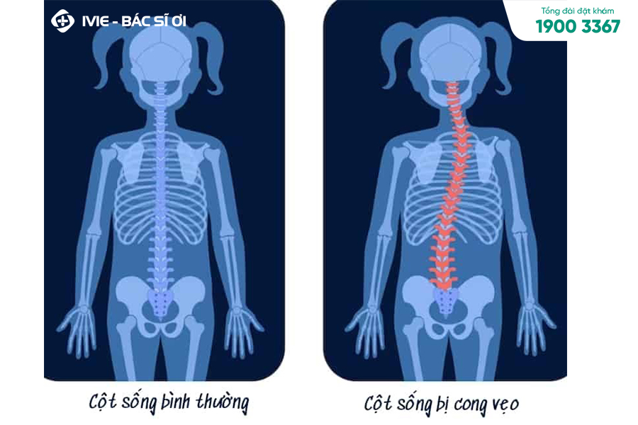 Trẻ bị cong vẹo cột sống nếu ngồi sai tư thế