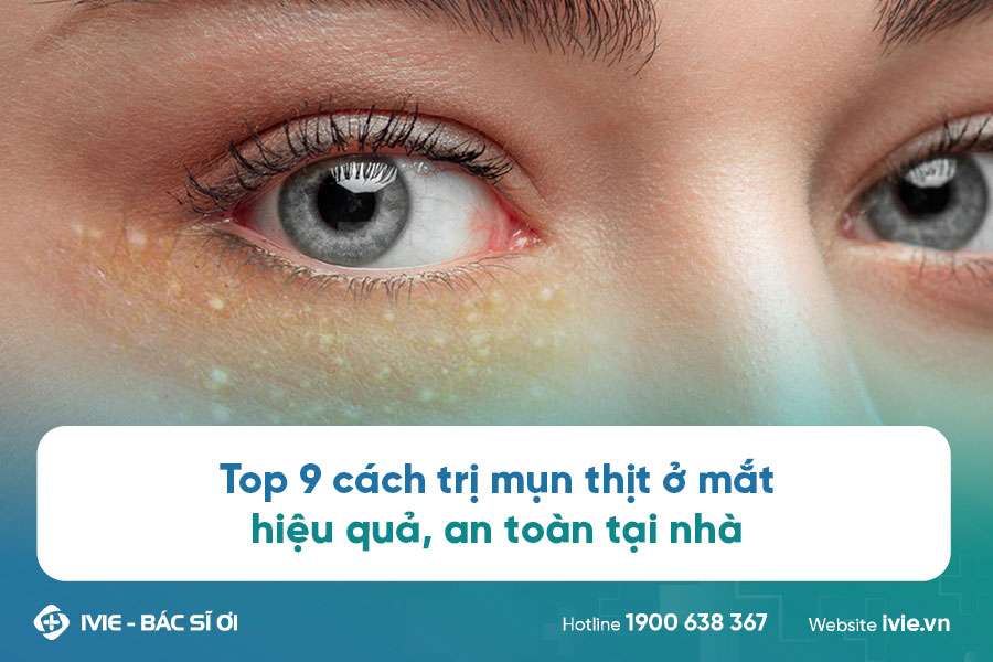 Top 9 cách trị mụn thịt ở mắt hiệu quả, an toàn tại nhà