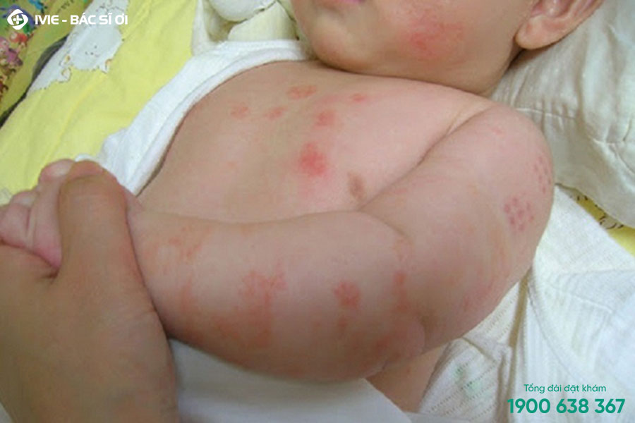 Vảy nến trên đối tượng trẻ em có da nhạy cảm và dễ kích ứng