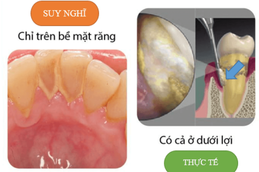 Cao răng thường xuất hiện tại đâu?     