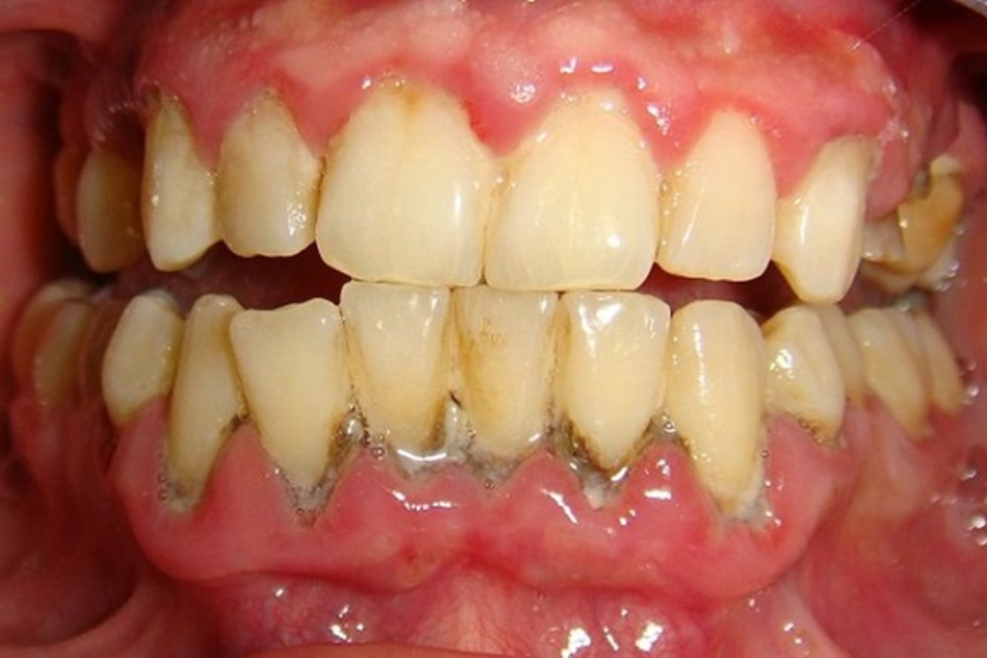 Lấy cao răng định kỳ mỗi 3 - 6 tháng một lần