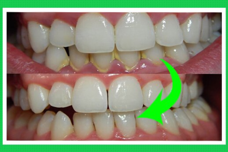 Lấy cao răng để cải thiện thẩm mỹ răng